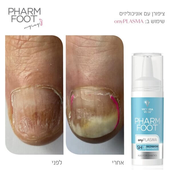 2onyPLASMA-אוניכולוזיס-לפני-ואחרי-5